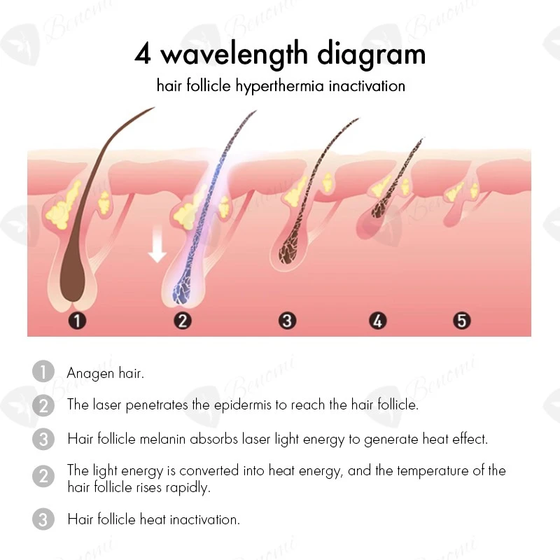 Laser Hair Removal Machine With USA Coherent Laser suppliers